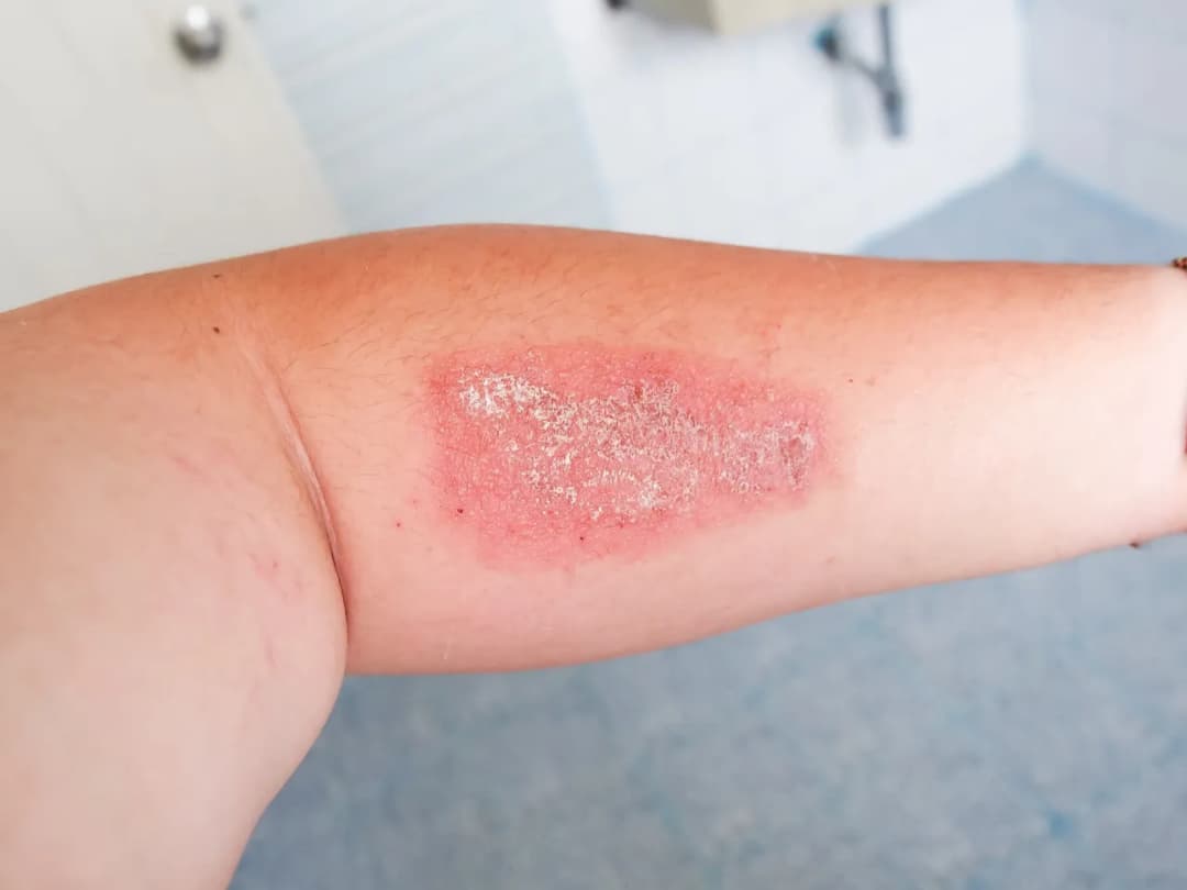 Niebezpieczne objawy gronkowca: rozpoznaj i zareaguj w odpowiednim czasie