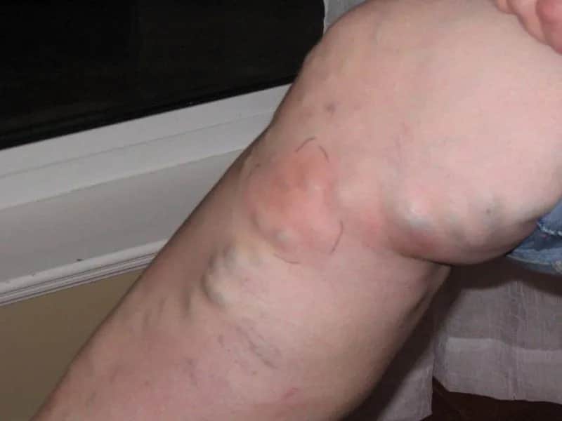 Objawy zakrzepicy - poznaj wszystkie sygnały alarmowe od lekarza